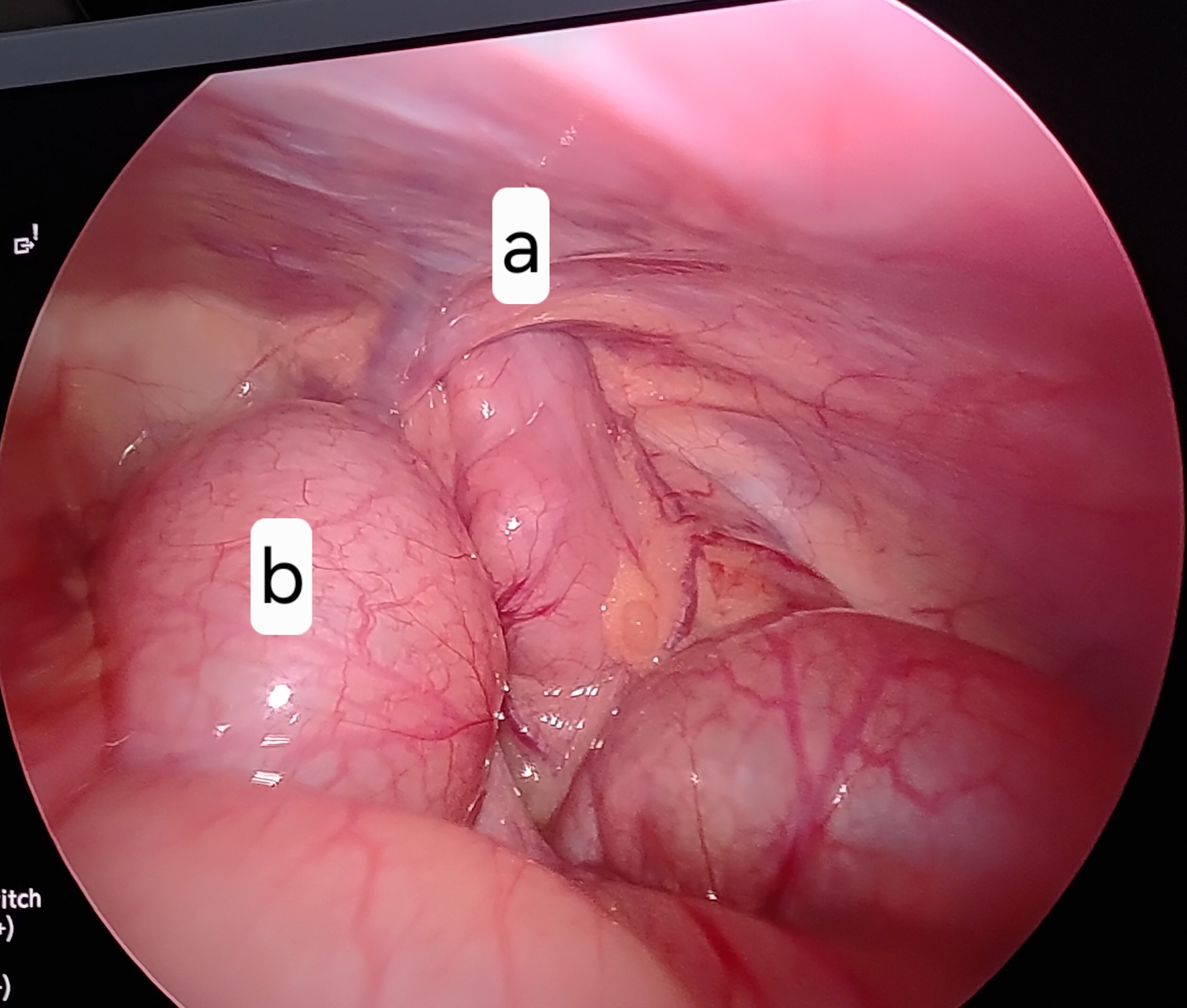 Laparoscopic management of pediatric inguinal hernia: A single-center experience